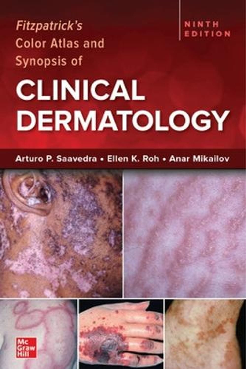 Fitzpatrick’s Color Atlas and Synopsis of Clinical Dermatology, Ninth Edition 9t